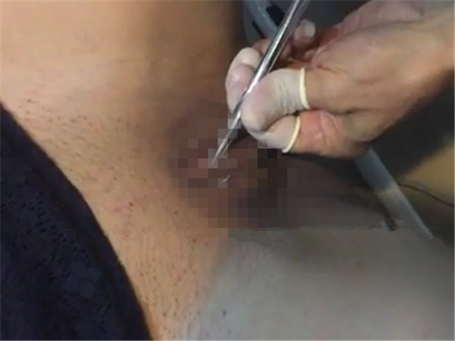 穿阴环,特写全过程